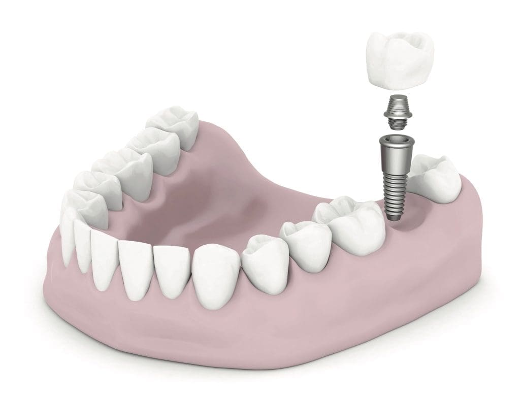 Dental implants