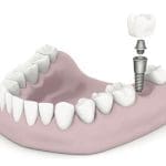 Dental implants