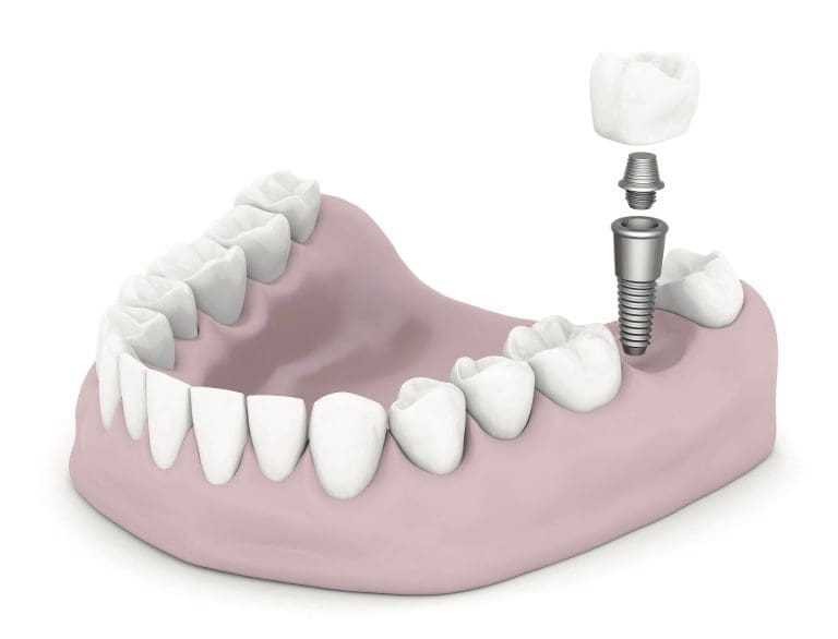 Dental implants