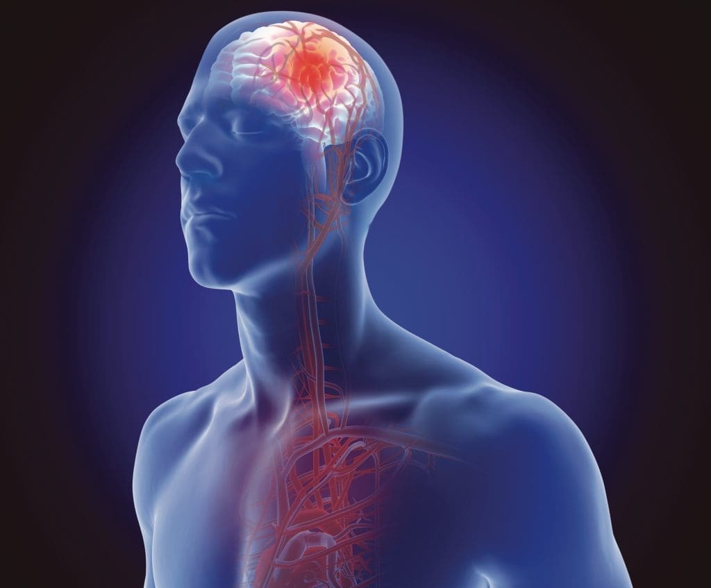 3D illustration of the of the blood vessels in the human brain and cerebrovascular disease or hemorrhagic stroke and causes o