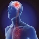 3D illustration of the of the blood vessels in the human brain and cerebrovascular disease or hemorrhagic stroke and causes o